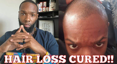 How To Naturally Restore Your Hairline With Urine Therapy!